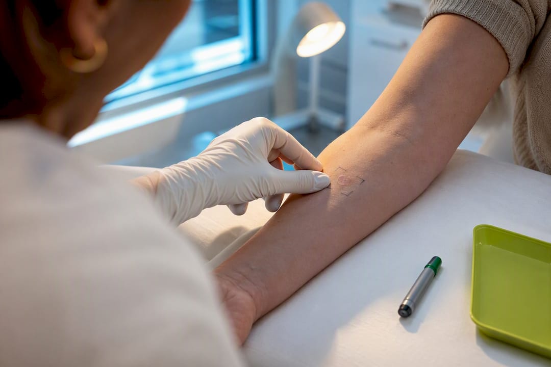 Clinician checking a marked forearm patch test